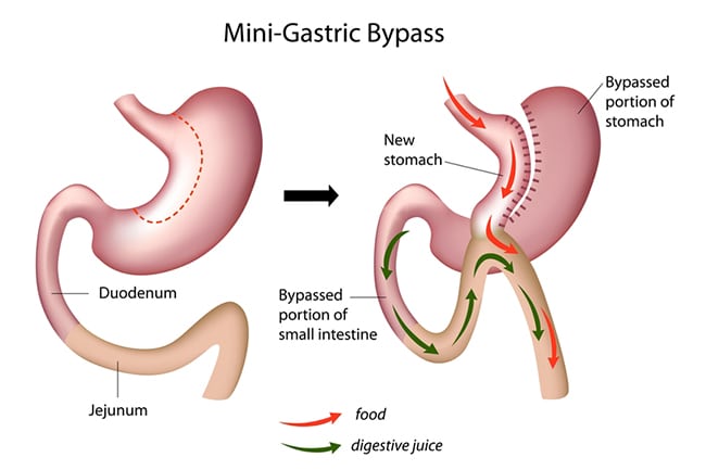 Laparoscopic-Gastric-Bypass-Riverside-Weight-Loss-Surgery-2
