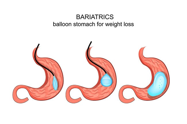 ORBERA-Non-Surgical-Intragastric-Balloon---Riverside-Weight-Loss-Surgery-