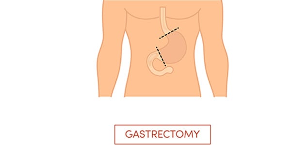 Laparoscopic-Sleeve-Gastrectomy-Riverside-Weight-Loss-Surgery