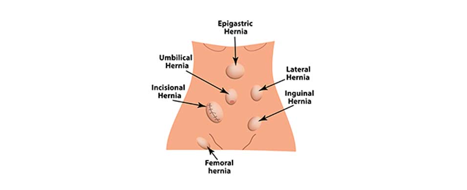 Epigastric-Hernia-Riverside-Weight-Loss-Surgery-1