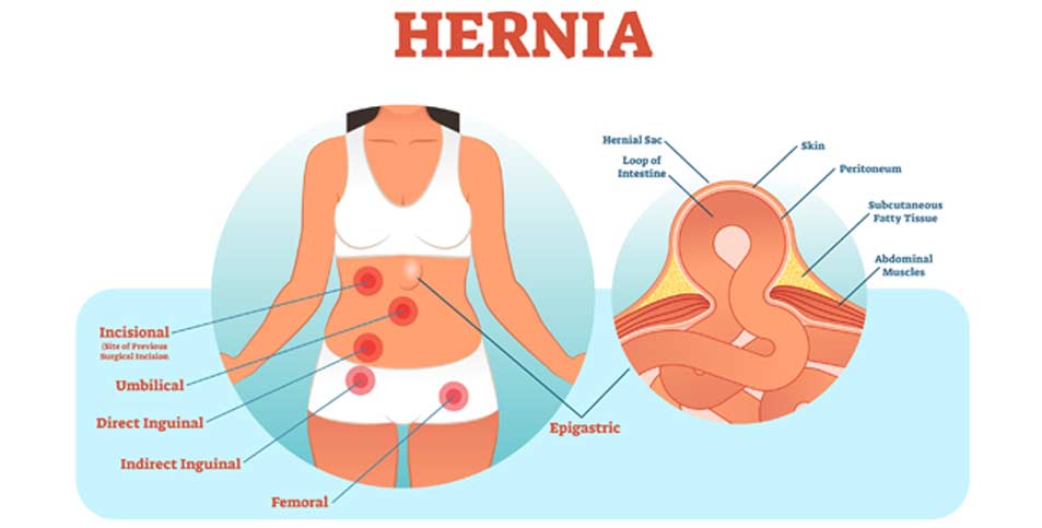 Femoral-Hernia-Riverside-Weight-Loss-Surgery