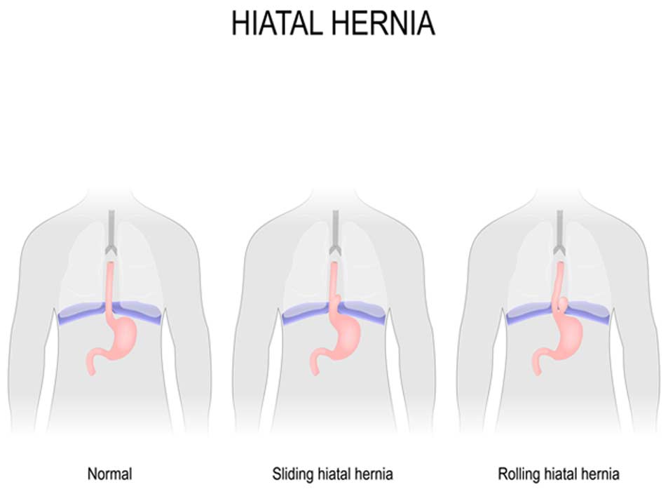 Hiatal-Hernia-Riverside-Weight-Loss-Surgery
