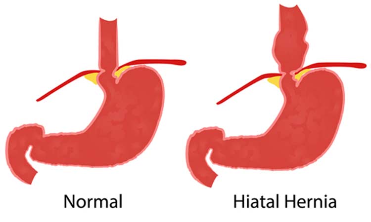 Hiatal-Hernia-Riverside-Weight-Loss-Surgery