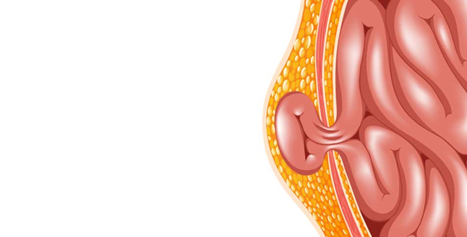 Umbilical Hernia Riverside Weight Loss Surgery